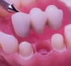 Протезирование зубов в Арзамасе